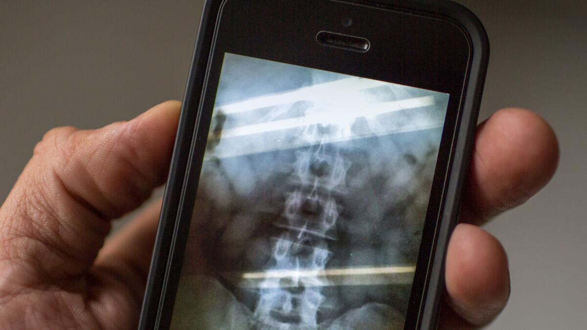 Una radiografía muestra el estómago de un sospechoso nigeriano en tráfico internacional de drogas detenido en el Aeropuerto Internacional de Guarulhos, en San Pablo. Se sospecha que el hombre ingirió cápsulas de cocaína e intenta viajar a Etiopía. Flavio Forner / para The Times.