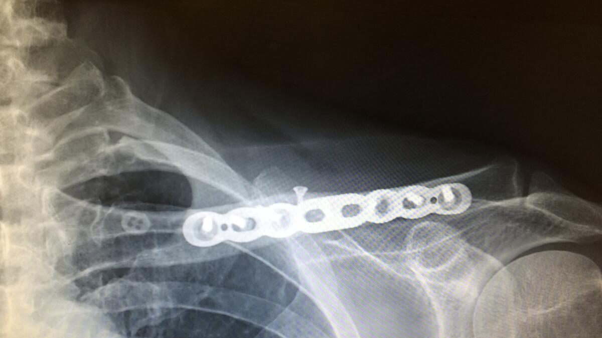 An X-ray image shows repair work on a broken collarbone suffered during an adventure ride near Death Valley.