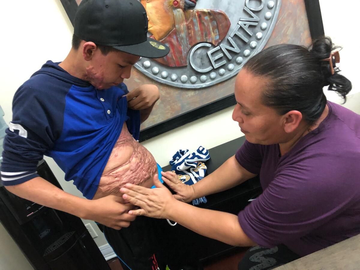 Flor de María Paz muestra las quemaduras que su hijo, David López, tiene en su abdomen sufridas en mayo de 2019.