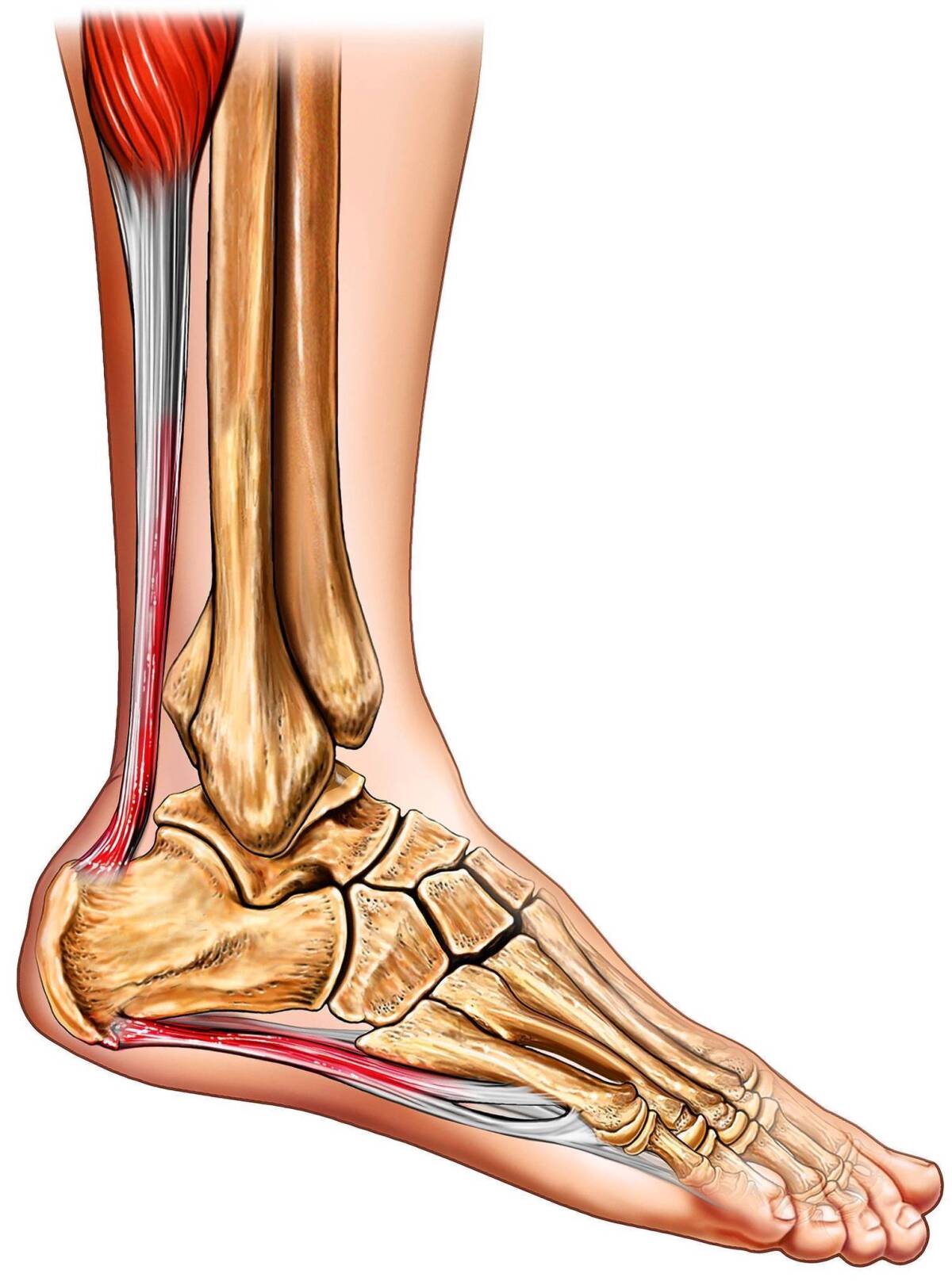 A medical illustration shows a foot with plantar fasciitis, inflammation of the band of tissue that runs from the heel along the bottom of the foot.
