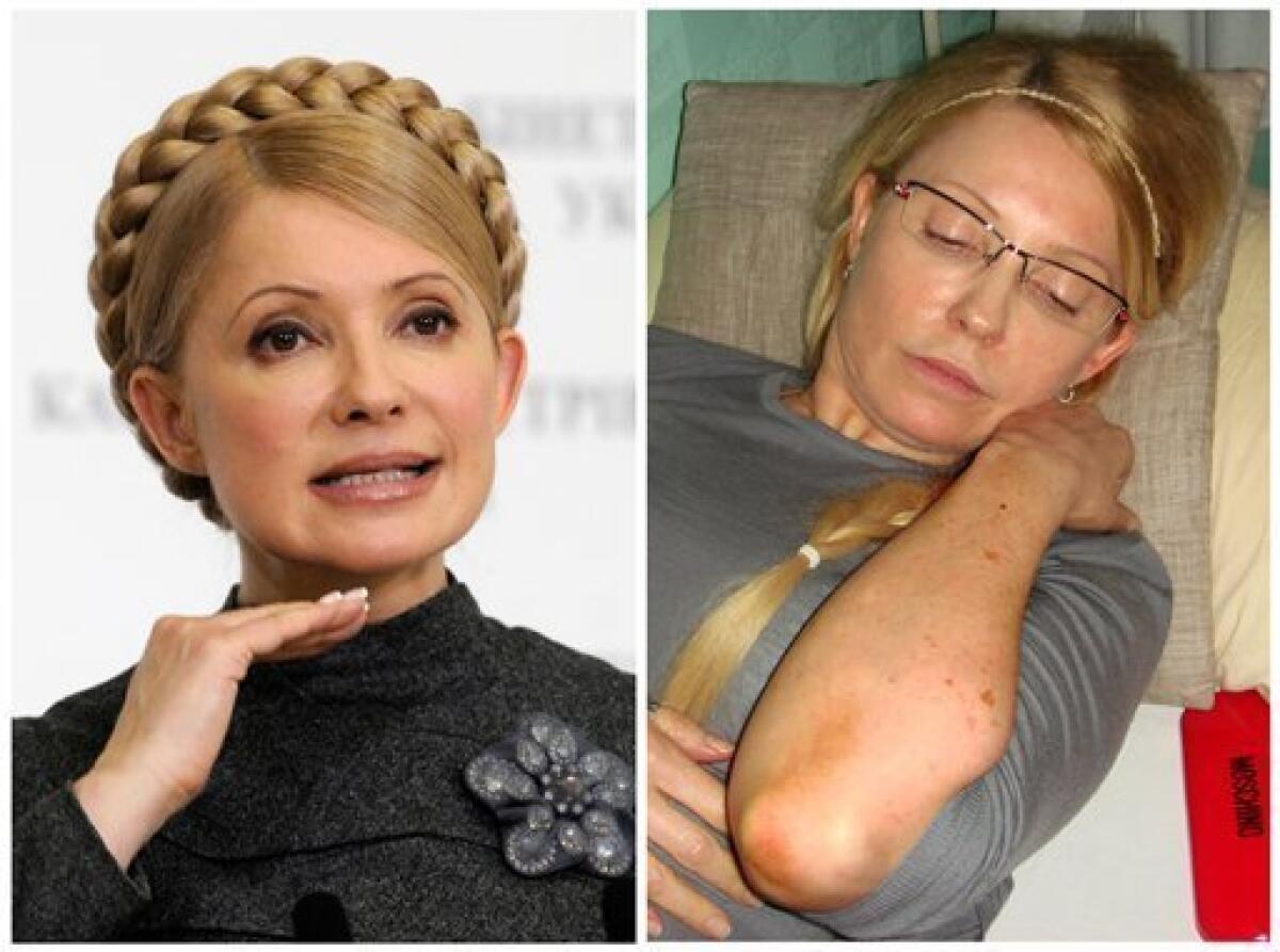 This combination of two photos shows on the left, in a Dec. 29, 2009 file photo, then Ukrainian Prime Minister Yulia Tymoshenko speaking to the media in Kiev, Ukraine, and on the right, in a photo provided by Ukrainian Pravda, taken Wednesday, April 25, 2012, Tymoshenko shows bruises on her body to the Ukrainian Commissioner for Human Rights in Kachanovskaya prison in Kharkiv, Ukraine, which she said she sustained when prison guards attacked her on Friday April 20 when trying to transport her to a local hospital against her will. (AP Photos)