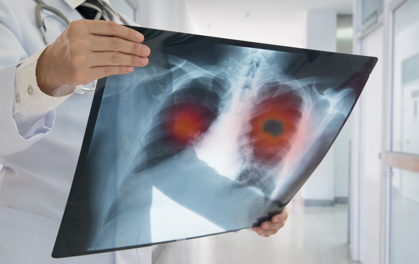 A doctor checks an X-ray image of a patient with lung cancer.