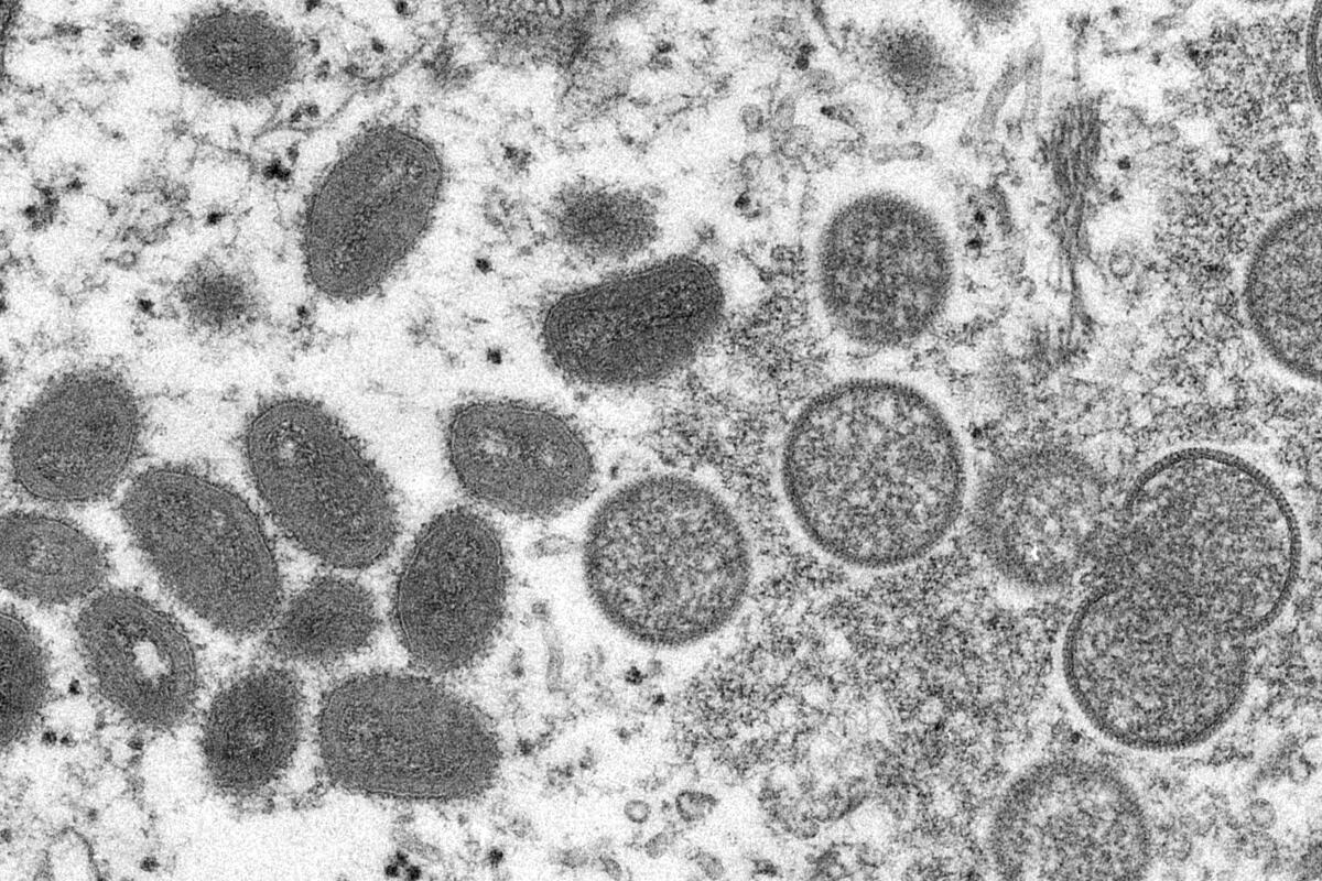 FILE - This 2003 electron microscope image made available by the Centers for Disease Control and Prevention shows mature, oval-shaped monkeypox virions, left, and spherical immature virions, right, obtained from a sample of human skin associated with the 2003 prairie dog outbreak. The spread of monkeypox in the U.S. in 2022 could represent the dawn of a new sexually transmitted disease, or it could yet be contained. Or it might be too early to tell. (Cynthia S. Goldsmith, Russell Regner/CDC via AP, File)