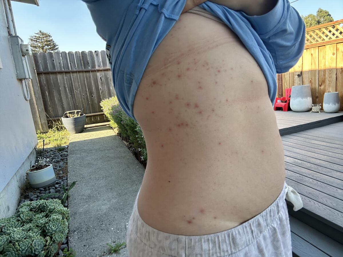 A rash caused by a suspected Aeromonas infection after participating in a Tough Mudder