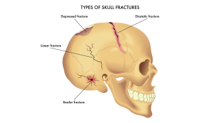 Skull Potential Injuries Skull Fractures: Causes, Symptoms, Diagnosis & Treatment - Los Angeles ...