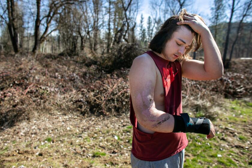 WEAVERVILLE, CA - MARCH 03: Chase Kirby,18, holds his arm that is on the mend after it was caught inside a machine at the paper mill during the pandemic on Wednesday, March 3, 2021 in Weaverville, CA. After high school athletics were canceled because if Covid Kirby decided to drop out of school and start work at the paper mill where he was injured. (Jason Armond / Los Angeles Times)