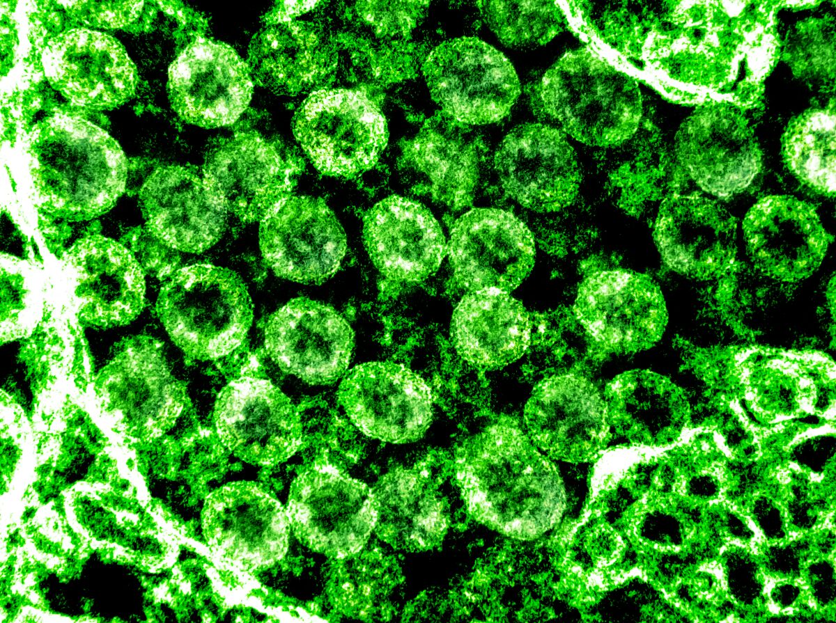 An electron micrograph of the coronavirus that causes COVID-19, isolated from a patient.