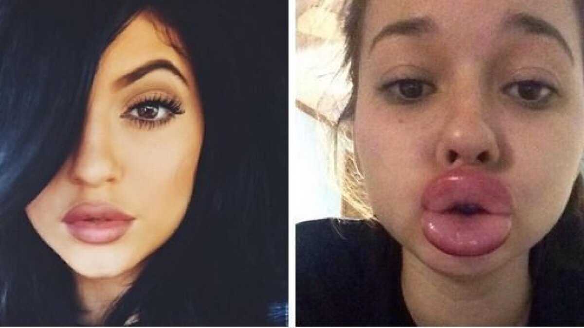 Kylie Jenner Lip Challenge Info Famous Person 