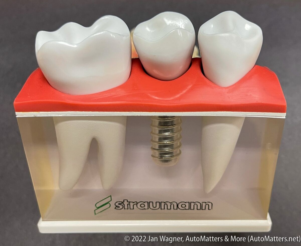 Model of dental implant in a jaw.