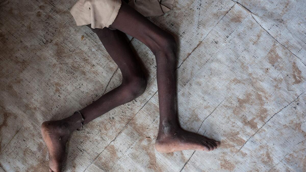 The legs of a young boy suffering from acute malnutrition at a camp outside Maiduguri, Nigeria.