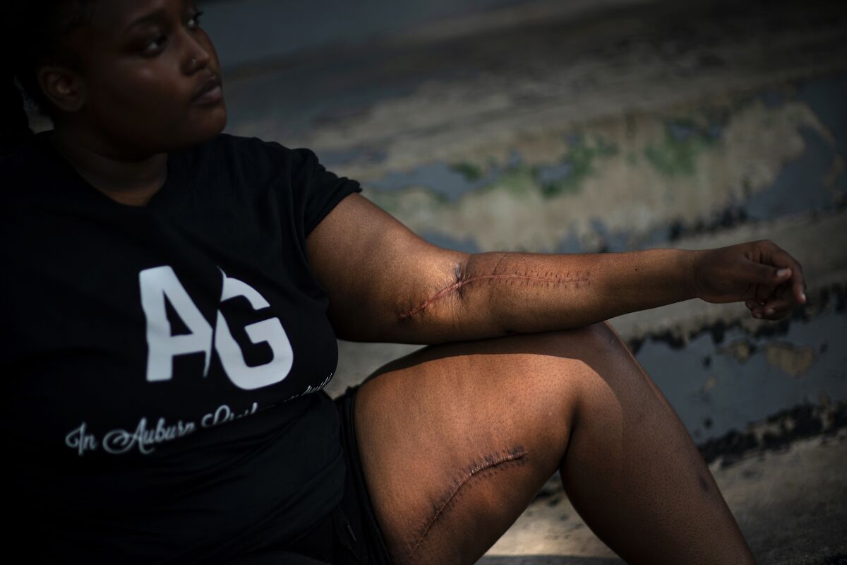 Teyonna Lofton, 18, shows the scars while sitting outside her home in the Auburn Gresham neighborhood in Chicago, Monday, Aug. 24, 2020, from surgeries to graft a vein from her leg to increase blood flow in her arm where she was shot. Lofton, a beaming high school graduate, had just been honored by friends and family with a car parade. As she waited at a gas station to buy a soft drink, shots rang out, and she fell hard. She prayed she would not die. In a chaotic year destined for the history books, Auburn Gresham, a Black community in Chicago, has written its own grim chapter, enduring a deadly virus, economic misery and gun violence, a constant state of turmoil that mirrors the tumult afflicting much of urban America. (AP Photo/David Goldman)