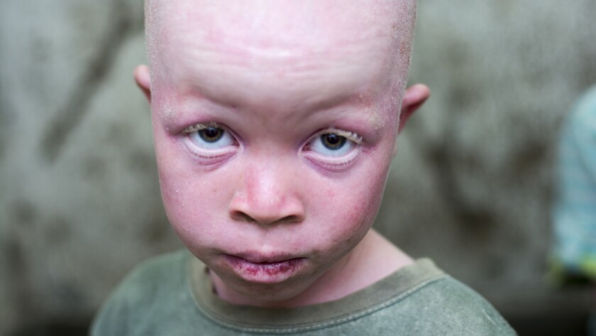 In Parts Of Africa People With Albinism Are Hunted For Their Body Parts The Latest Victim A 9 Year Old Boy Los Angeles Times