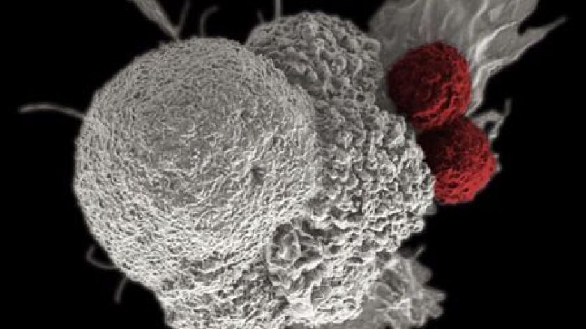 False-color scanning electron micrograph depicts oral squamous cancer cell (white) being attacked by to T cells (red), part of the natural immune response.