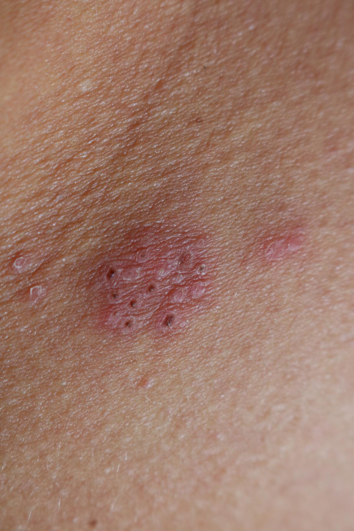 A reddish skin rash with dark spots