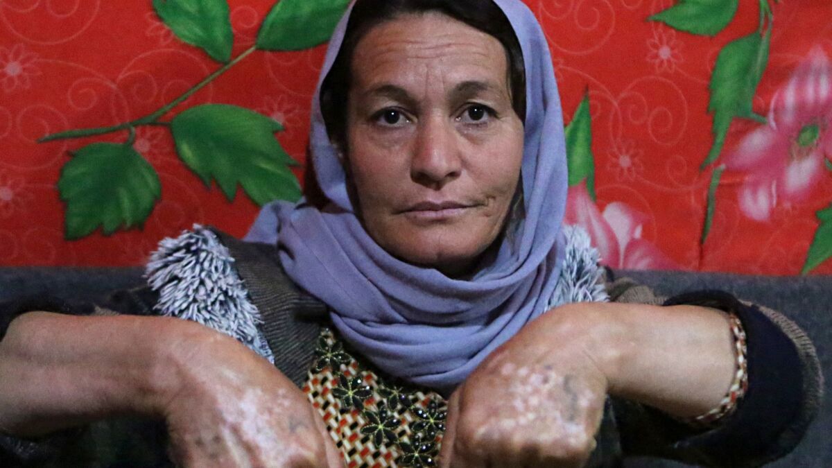 Baseh Hammo, a Yazidi woman who escaped enslavement by Islamic State and made it to a displaced person's camp in Iraq, shows some of the injuries she suffered.