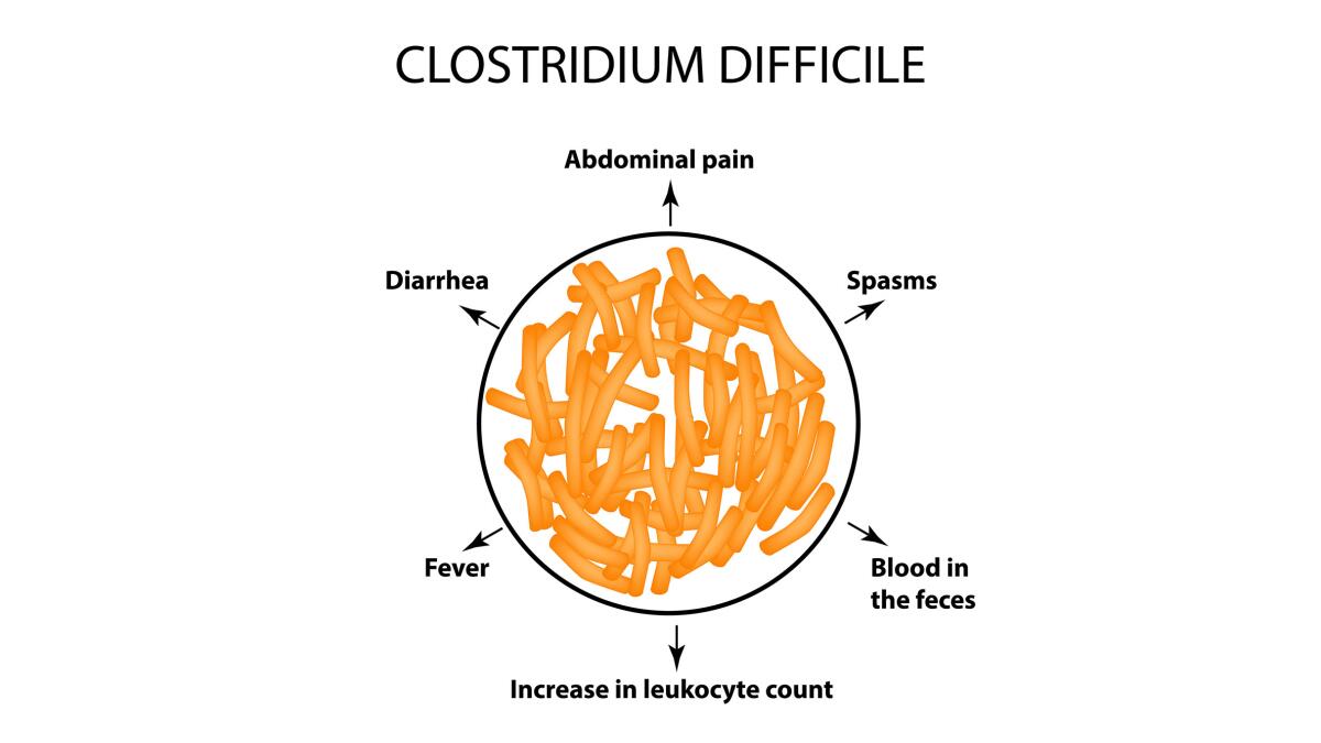 Clostridium difficile. Pathogenic flora. The bacterium causes intestinal diseases. Symptoms of infection. Infographics.