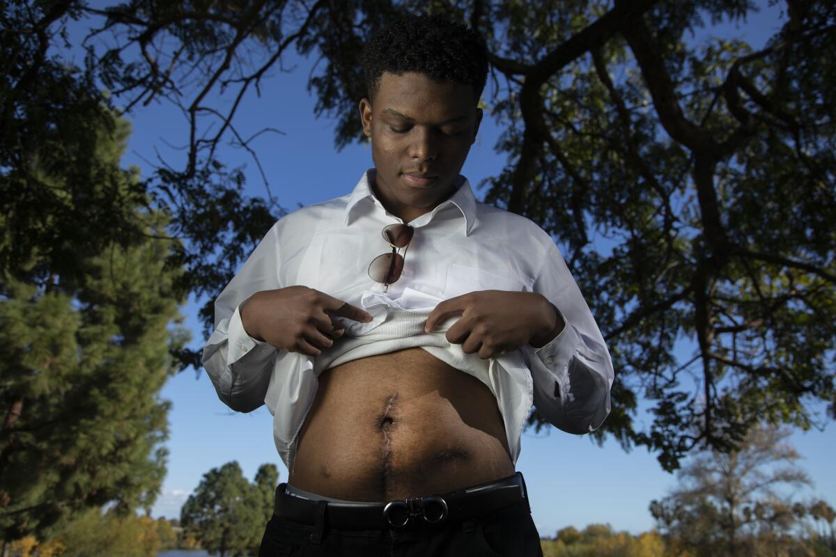 A boy shows his gunshot wound