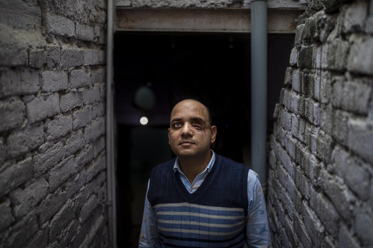 A man with one eye missing poses for a portrait in a stairwell at his home