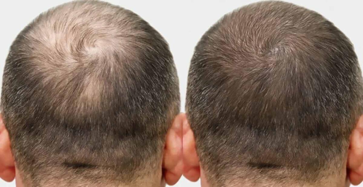 Laser Hair Restoration