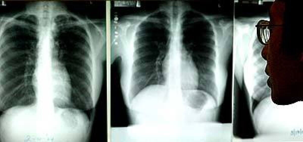 At a clinic in L.A., Dr. Alvin Chin studies chest X-rays for evidence of TB. In 2002, 3,169 cases of TB were diagnosed in California.