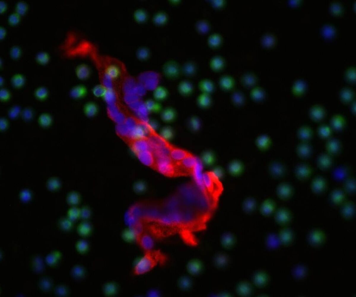 Scripps' new HD-CTC blood test uses a chemical to illuminate abnormal cells (shown in red.) Scripps Research