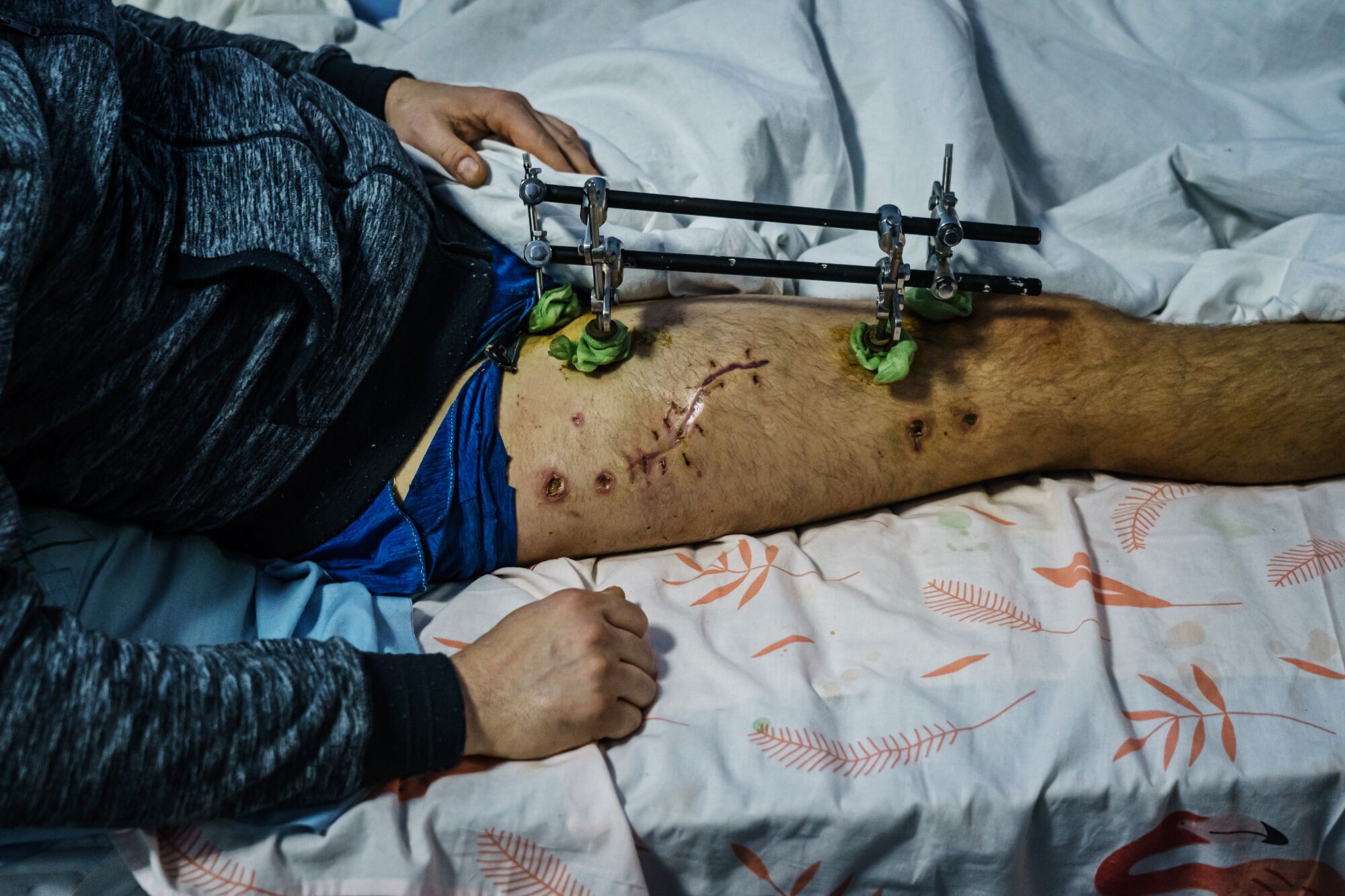 The leg of a patient shown with gunshot wounds and a medical device attached on top.