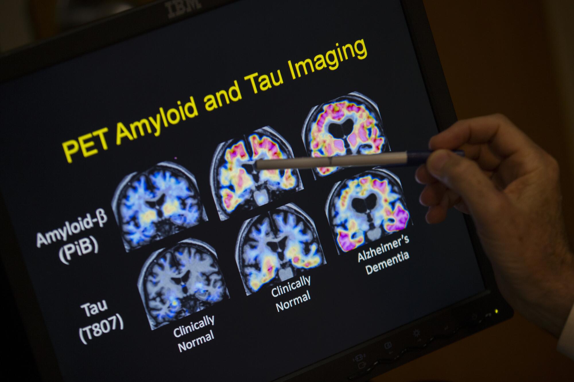 A doctor points to PET scan results that are part of a study on Alzheimer's disease at a hospital in Washington. 