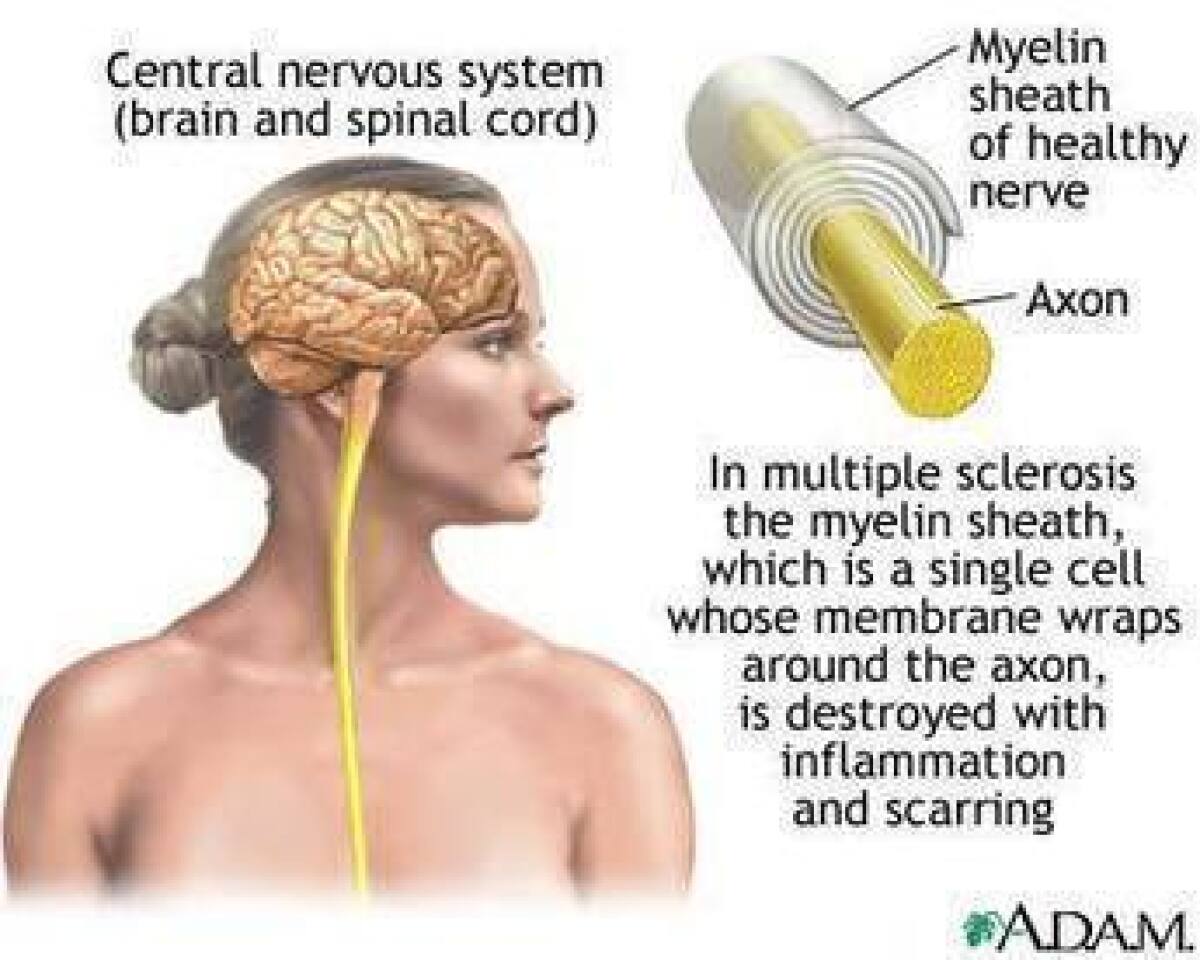 A drug currently used to treat leukemia is also effective at treating relapsing-remitting multiples sclerosis.