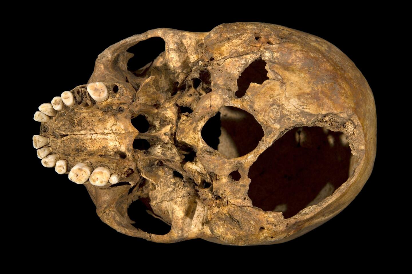 Fatal injuries on Richard III's skull
