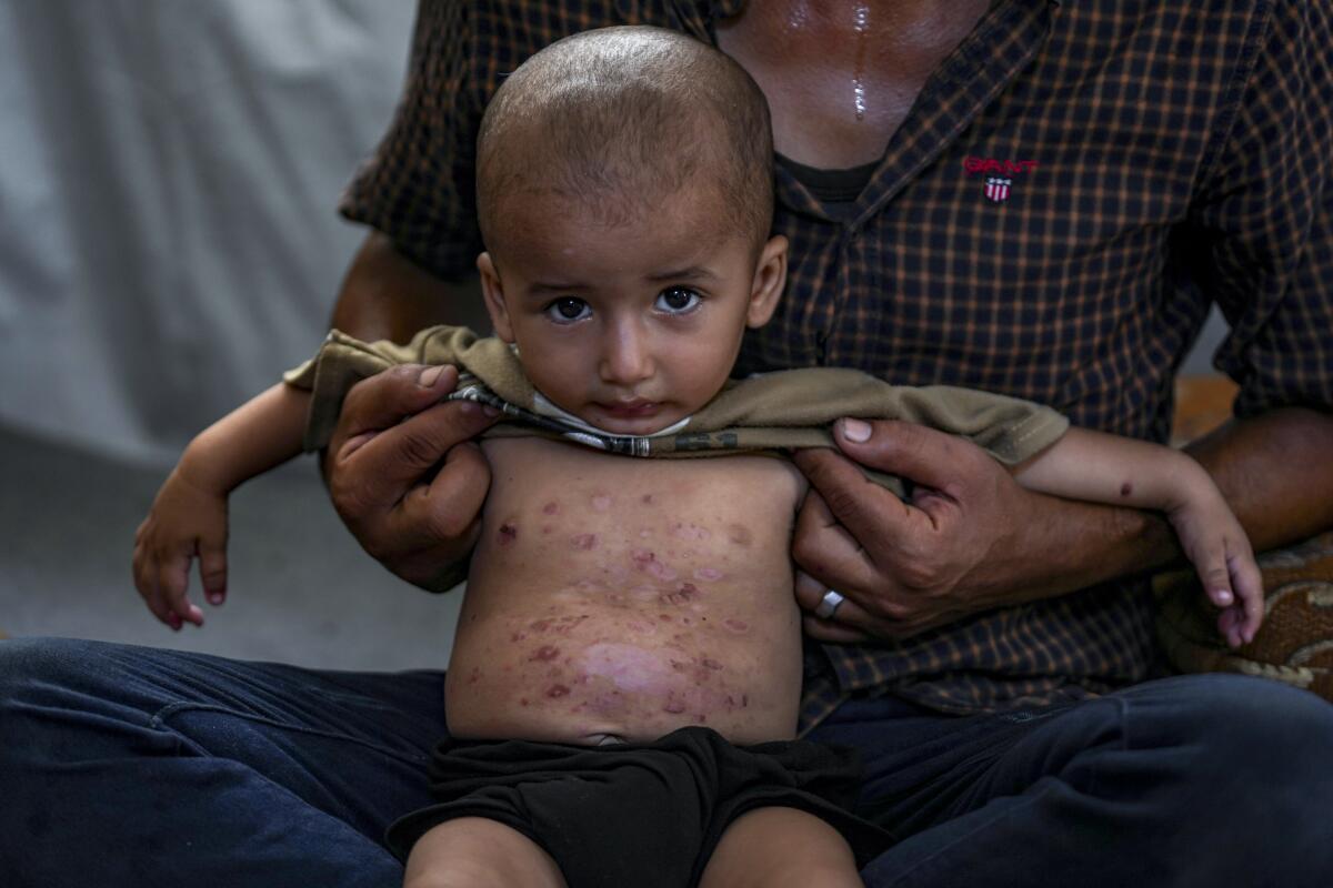 Mohammed Abu Obaid, un niño palestino que padece una enfermedad 