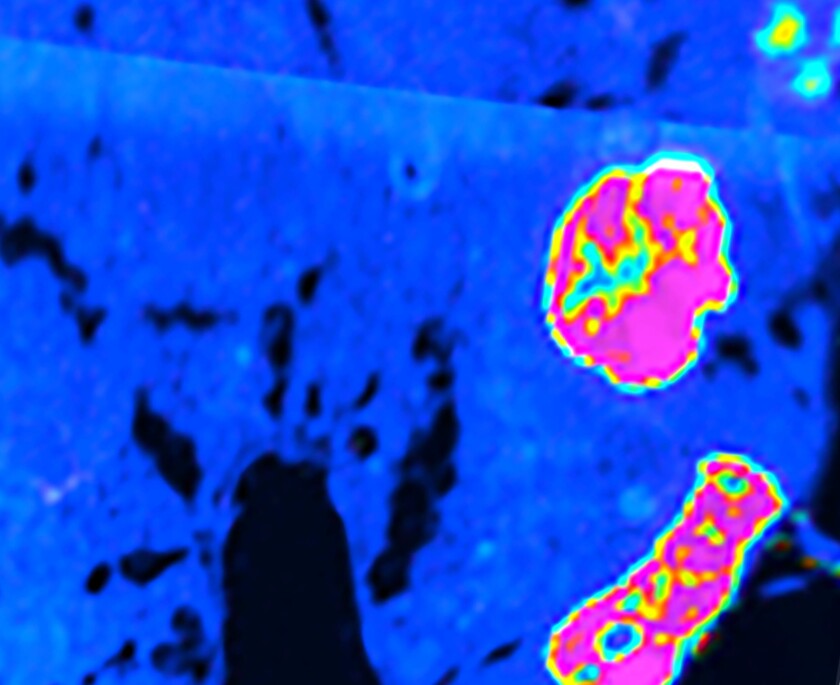Cells inside an islet of Langerhans within the pancreas. Islet beta cells make insulin. Older cells have a yellow-to-pink color scheme, while younger cells exhibit a blue-to-green color pattern.