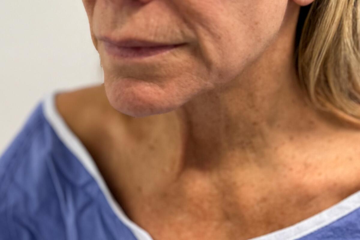 One of Dr. Suzanne Trott's cosmetic surgery patients before her lower face lift and chin lift in November.