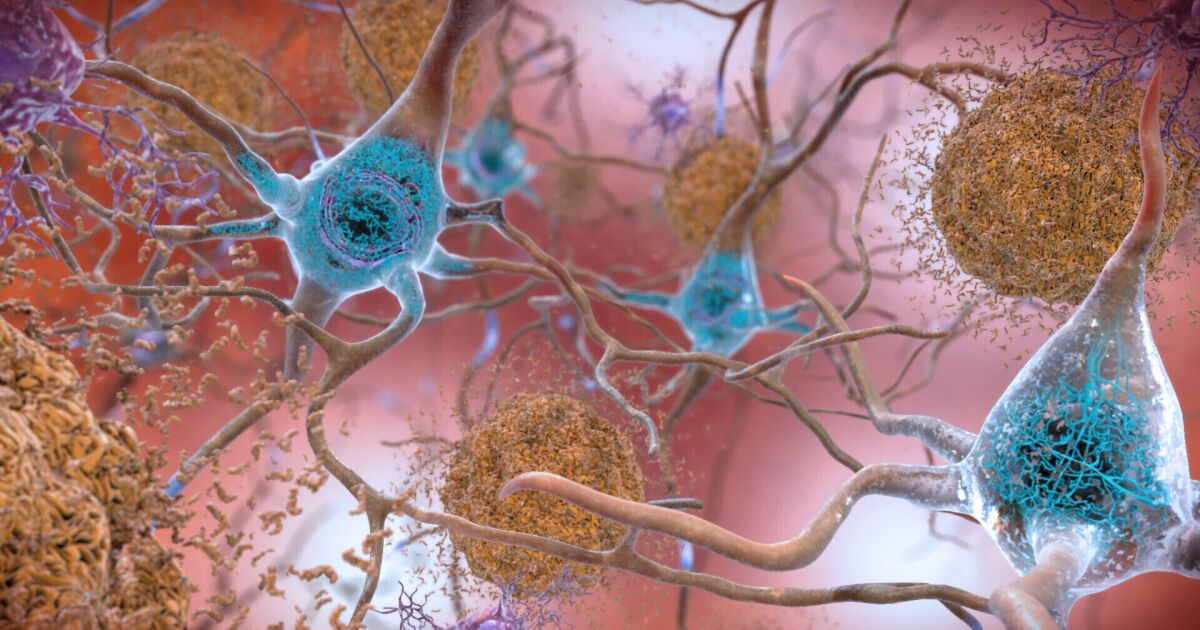 Pourquoi les médicaments contre la maladie d’Alzheimer sont moins prometteurs que la prévention