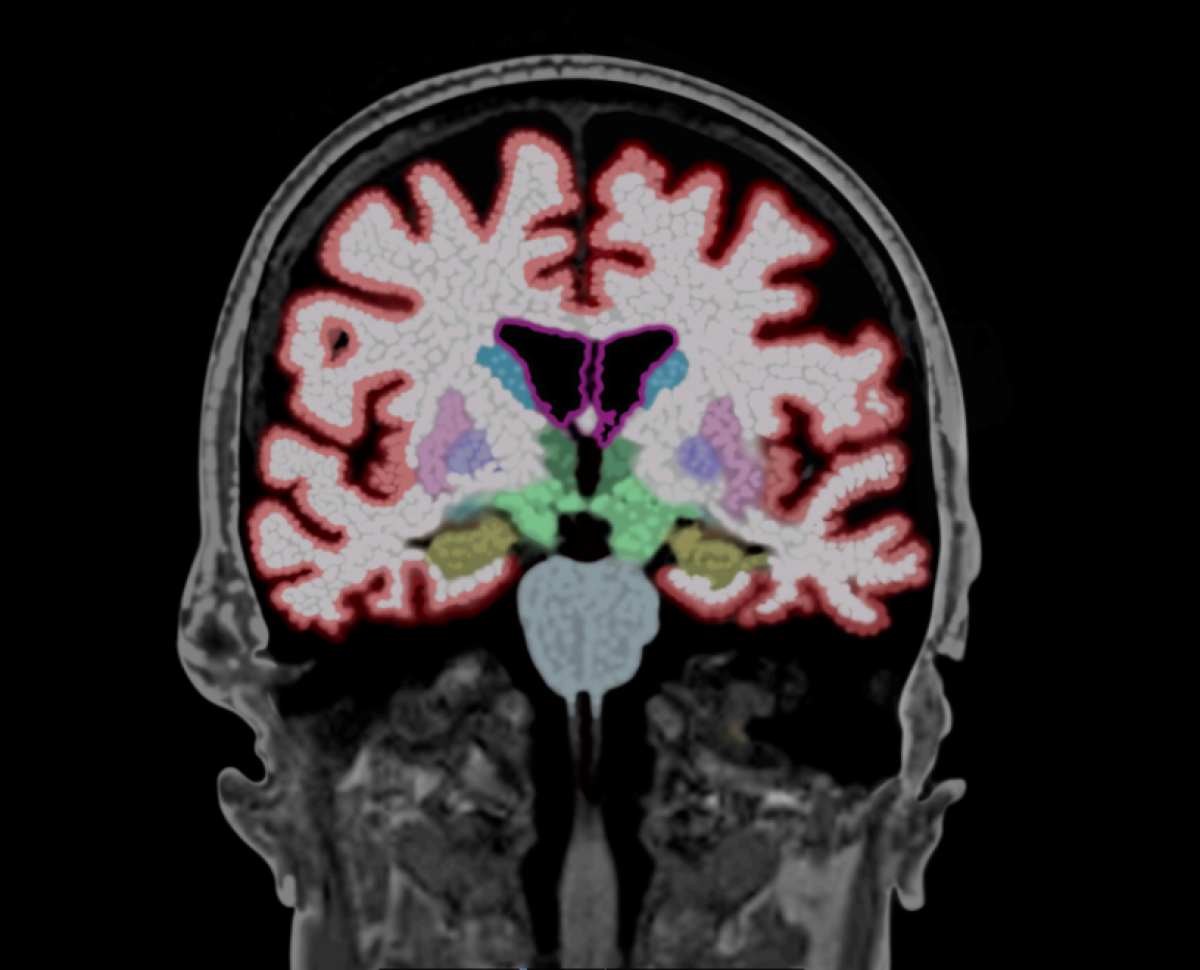Scientists are experimenting with gene therapy to try to find an effective treatment for Alzheimer's disease.