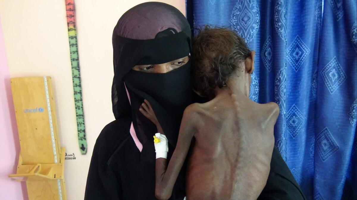 Nadia Nahari holds her 5-year-old son, Abdelrahman Manhash, at a treatment clinic in Hudaydah, Yemen, last month. The hospital cannot meet the needs of all the malnourished children who arrive daily.