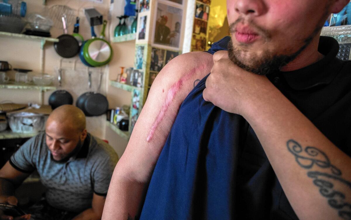 Michael Williamson shows the scar from his shooting by a Chicago police officer.