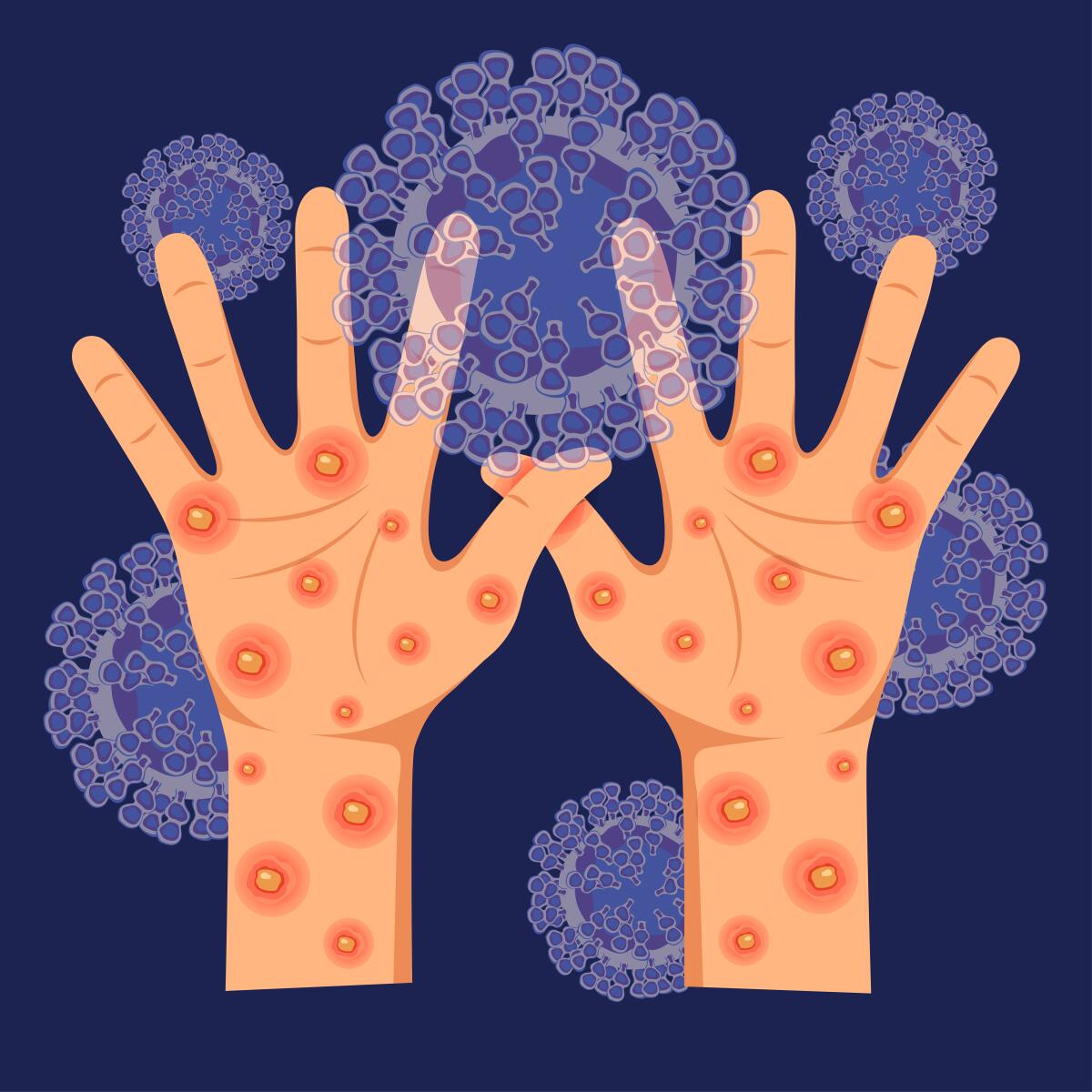 Human hands with monkeypox virus on the microscopic background of the virus