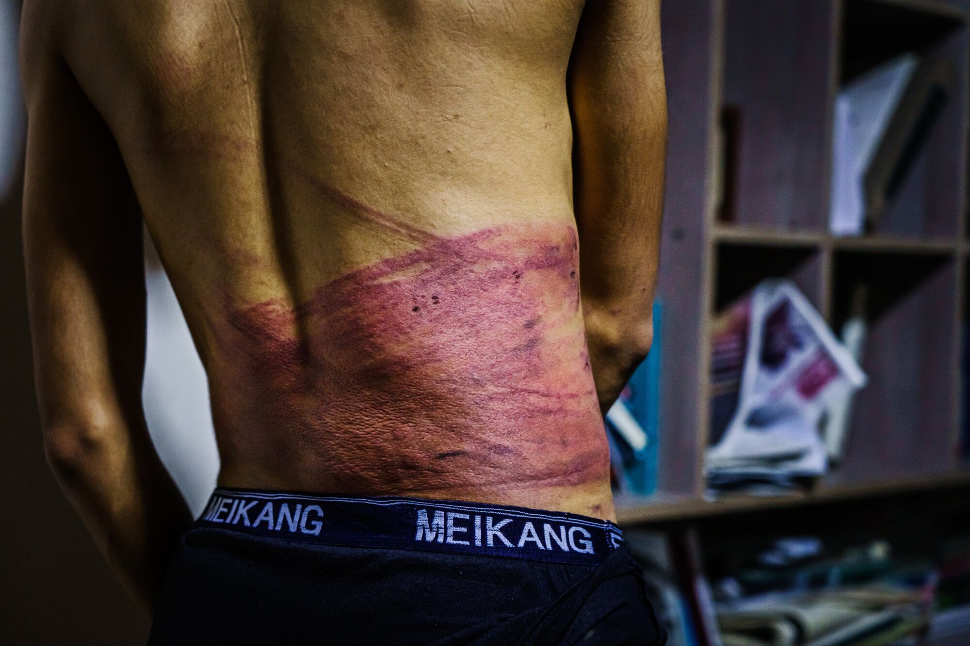 Journalist Taqi Daryabi displays his purple wounds on his lower back.