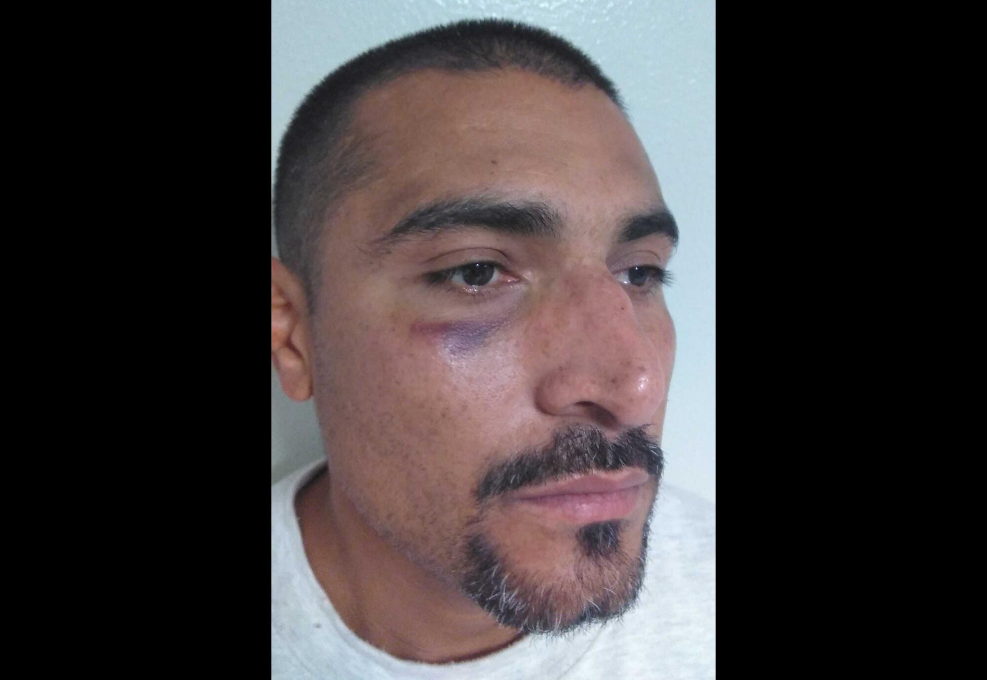 A man with bruising under and around his right eye