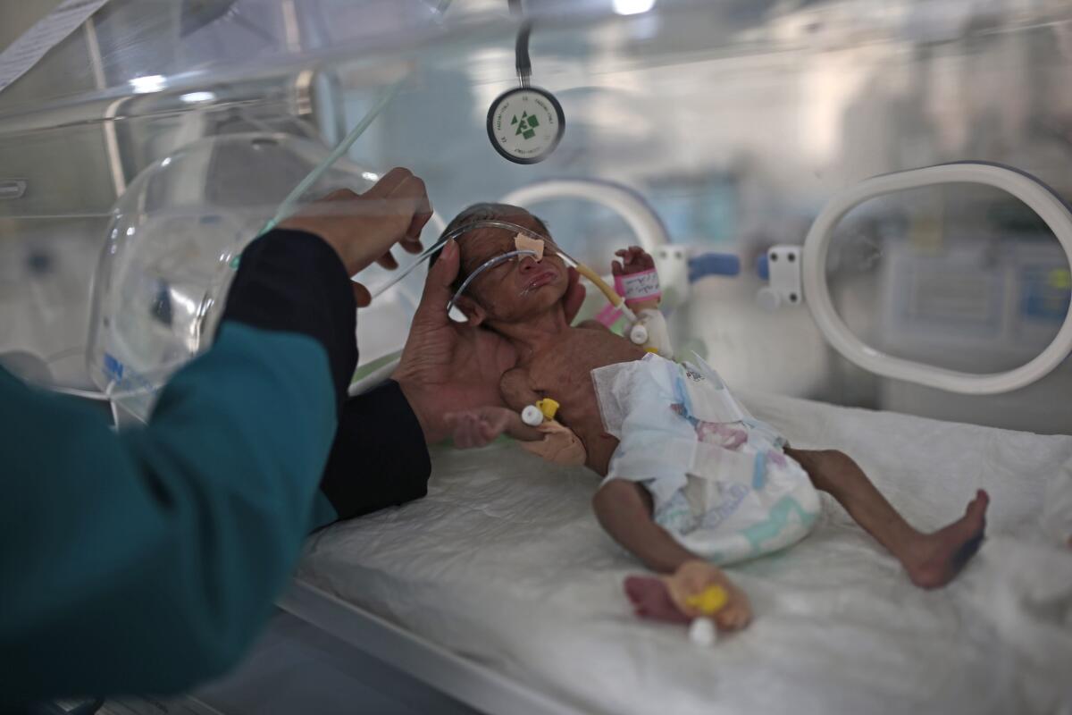 A malnourished infant at a hospital.