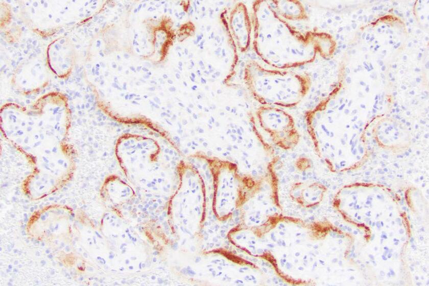 This microscope image provided by the College of American Pathologists and Archives of Pathology and Laboratory Medicine shows placental cells from a stillbirth with SARS-CoV-2 infection indicated by the darker stains. Research published on Thursday, Feb. 10, 2022 suggests the coronavirus can invade and destroy the placenta in a deadly process that may be a major cause of stillbirths in infected pregnant women. (College of American Pathologists, Archives of Pathology and Laboratory Medicine via AP)