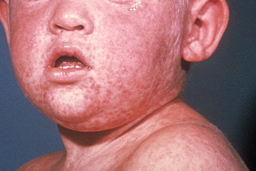 Face of boy after three days with measles rash.