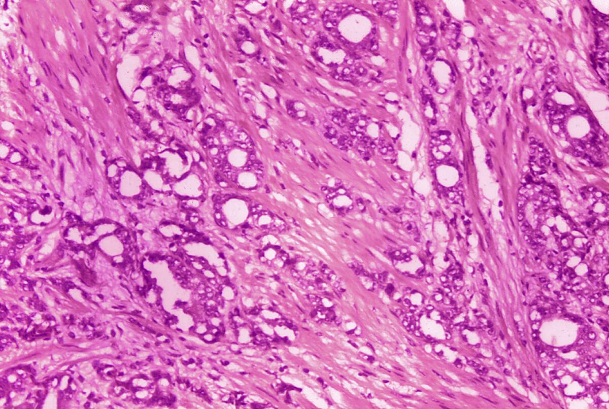 This 1974 microscope image shows changes in cells indicative of adenocarcinoma of the prostate.