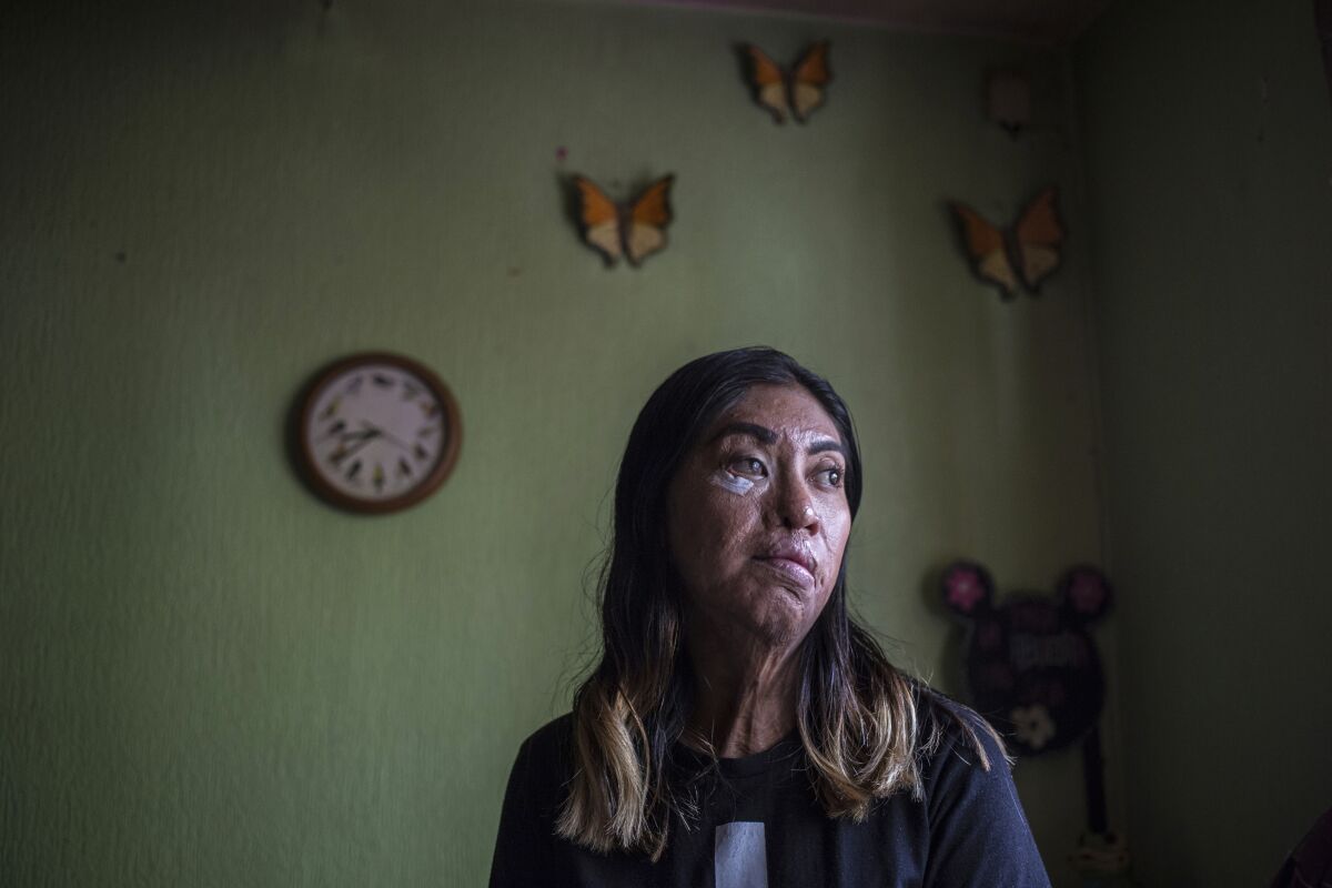 Esmeralda Millan, who survived an acid attack by her ex-partner three years ago when she was 23, poses for a portrait at her grandmother's home in the state of Puebla, Mexico, Tuesday, June 22, 2021. Millan’s attacker was arrested and jailed on charges of attempted femicide the same year of the attack, which has forced her to have 43 operations to regain some mobility, and she awaits another on her eye. (AP Photo/Ginnette Riquelme)