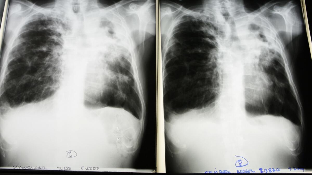 X-rays from a tuberculosis patient.