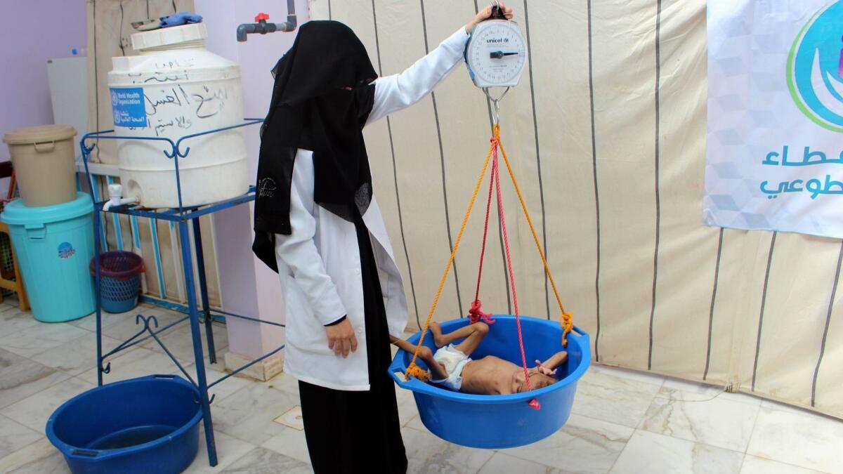 A child suffering from severe malnutrition is weighed in a hospital in Yemen's northwestern Hajjah province on Nov. 7.