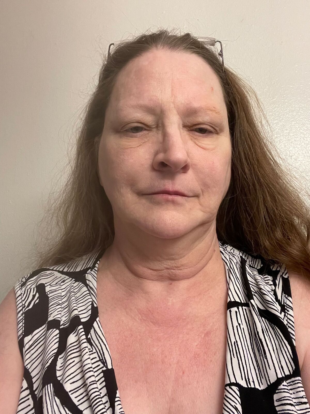 Marilyn Bloomer of Oceanside, California, has a condition known as mast cell activation syndrome.