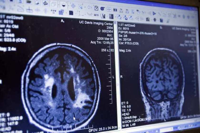Patient brain scans are shown at the Alzheimer's Disease Center at UC Davis School of Medicine.