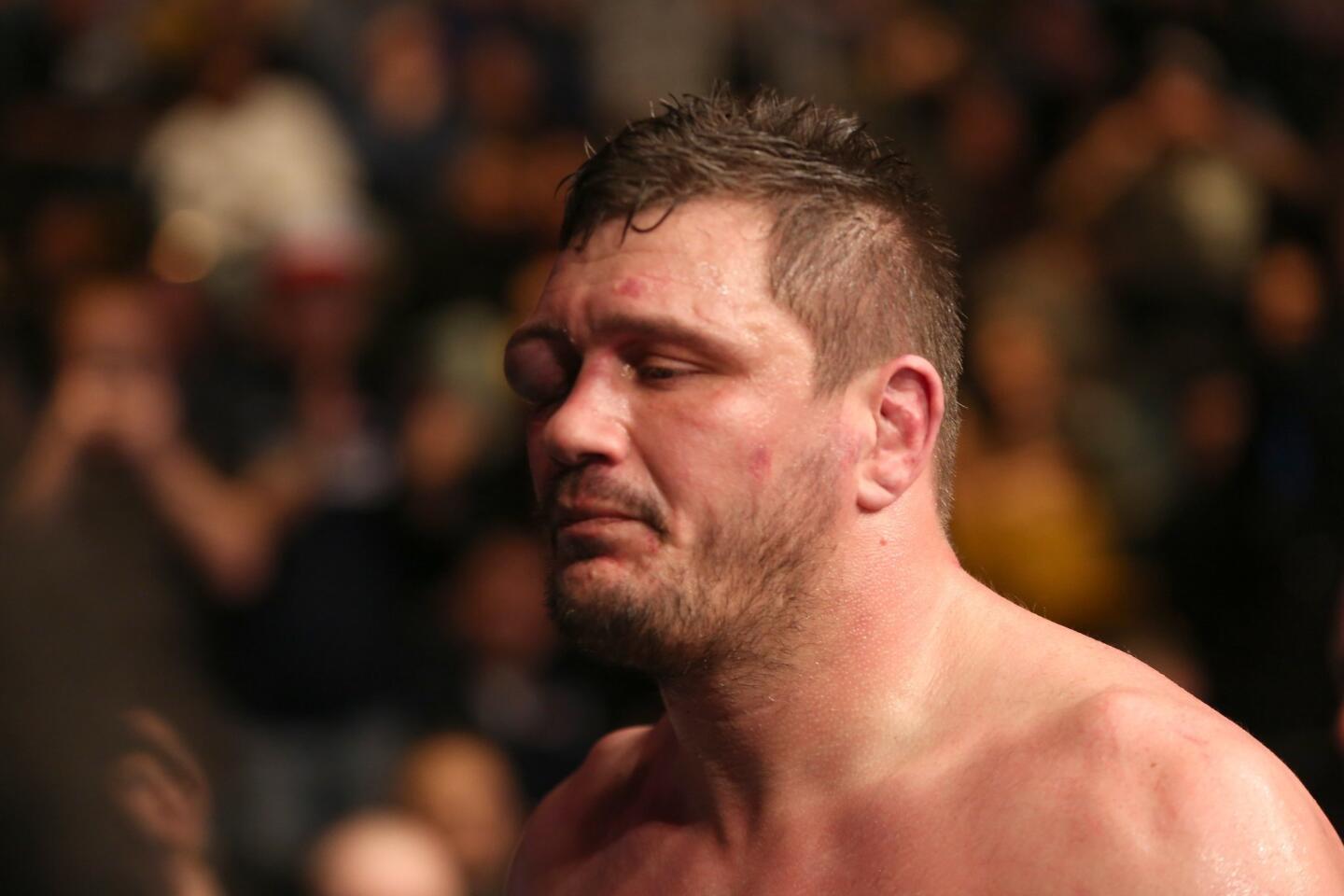 Matt Mitrione's damaged eye is seen after his bout with Travis Browne walking back to the dressing room after their mixed martial arts bout at UFC Fight Night 81, Sunday, Jan. 2, 2016, in Boston. Browne won via third round TKO. (AP Photo/Gregory Payan)