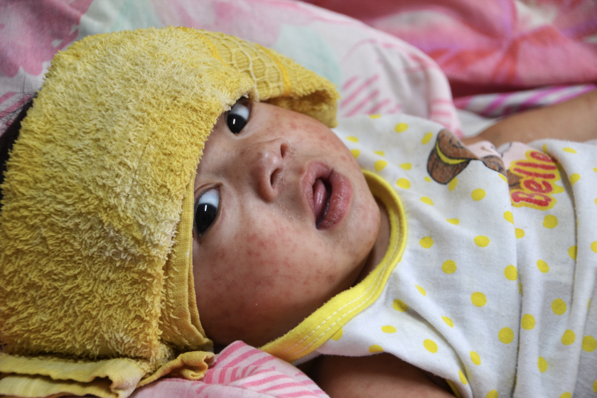 A baby hospitalized with measles.